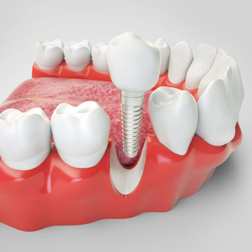 Dental Implants