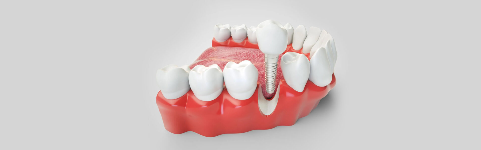 Dental Implants