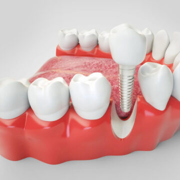 Dental Implants