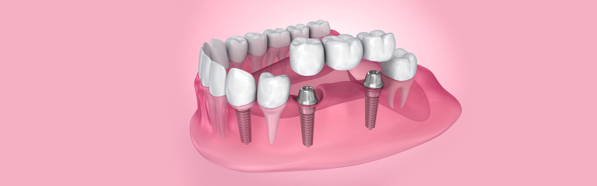 Dental-Bridges