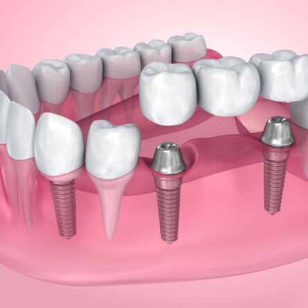 Dental-Bridges