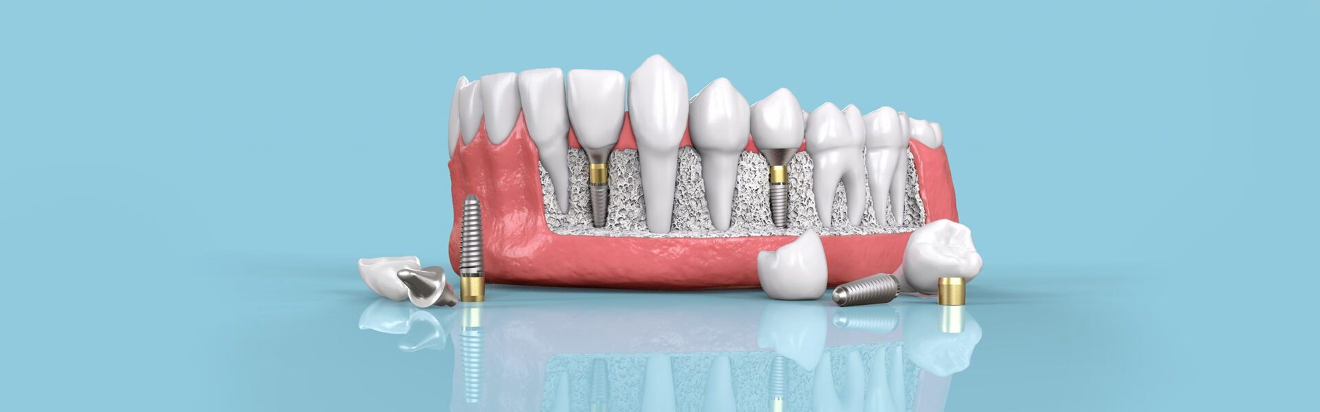 Dental-Implants