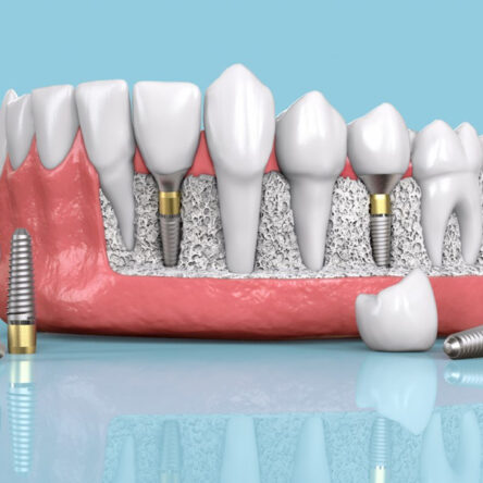 Dental-Implants